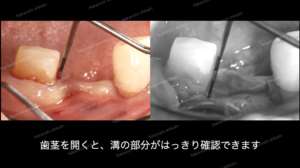 歯周病　歯周歯周外科について　歯茎をめくると溝の深さがはっきりわかります